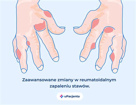 Reumatoidalne zapalenie stawów objawy i leczenie