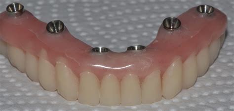 Implant Supported Bridge Denture All On Applecross House Dentist