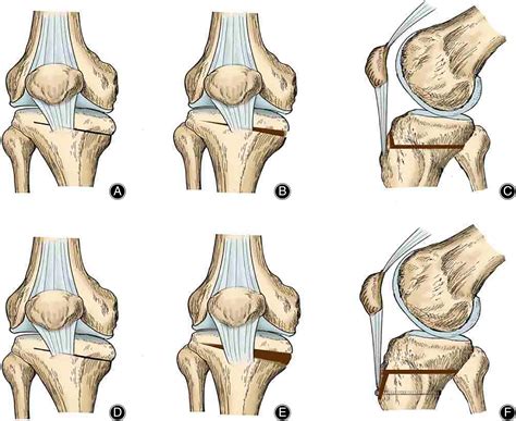 Osteotomy Around The Knee The Surgical Treatment Of Osteoarthritis