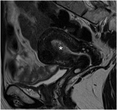 Pelvic Magnetic Resonance Image Sagittal T Weighted Magnetic