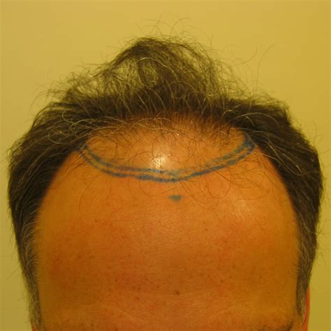 The Price Of A New Forehead: 5 Crucial Factors That Determine The Cost Of A Hairline Transplant