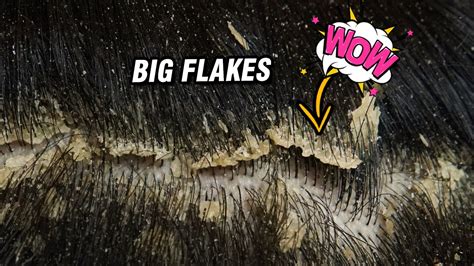 Big Flakes Scratching Satisfying Dandruff Removal 1267 Youtube