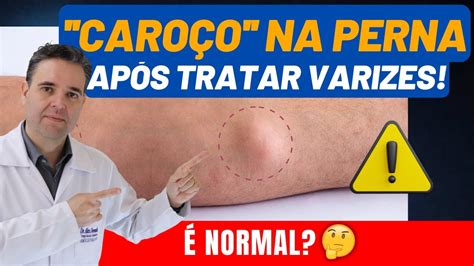 Nódulos na perna após a tratamento de varizes Isso é normal Dr