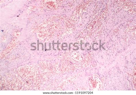 Capillary Hemangioma Light Micrograph Photo Under Stock Photo