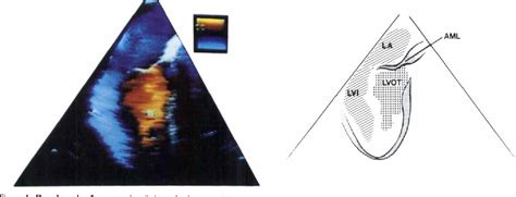 Figure 1 From Intraoperative Transesophageal Color Flow Mapping