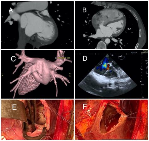 Cor Triatriatum Sinister A Rare Congenital Phenomenon In Our Everyday