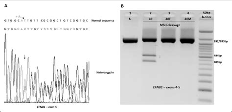 Novel Frameshift Mutation C717dupa Pleu240ilefster79 In Efnb1 Gene