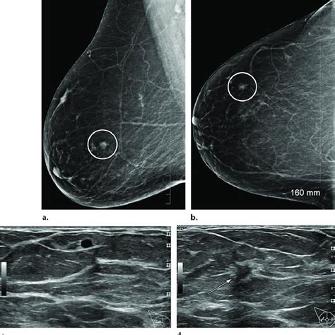 Mlo Mammography Quadrants Clock