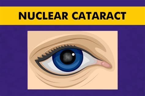 Nuclear Cataract - Symptoms, Causes & Treatment | Centre For Sight