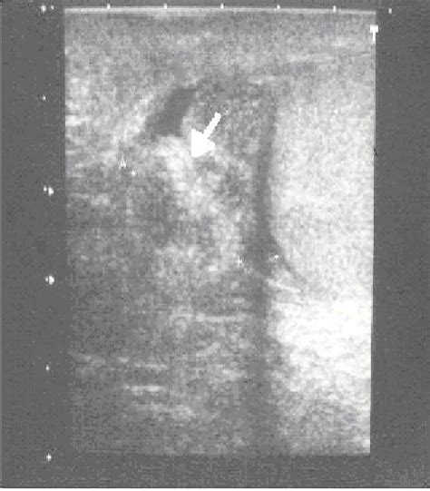 Ultrasound Demonstrating Epididymal Swelling Consistent With