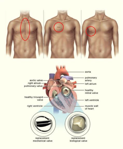 Minimally Invasive Mitral Valve Surgery Dr Suresh Bhagia