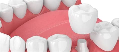 What Are The Pros And Cons Of Dental Crowns Hello Smile Dental