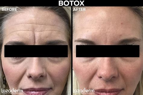 5 Top Tips to Find The Best Botox Injector Near Me — Lazaderm Laser ...