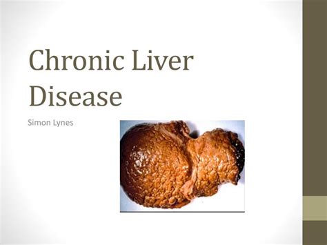 Ppt Chronic Liver Disease Powerpoint Presentation Free Download Id 1999382