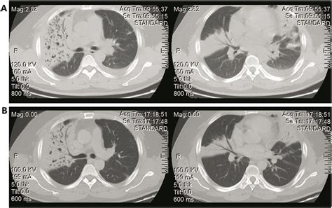 The Chest Ct Showed Bilateral Areas Of Consolidation And Little Pleural Download Scientific