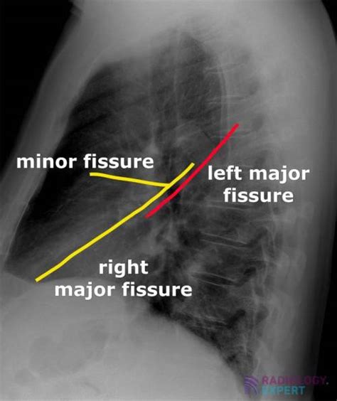 Chest X Ray