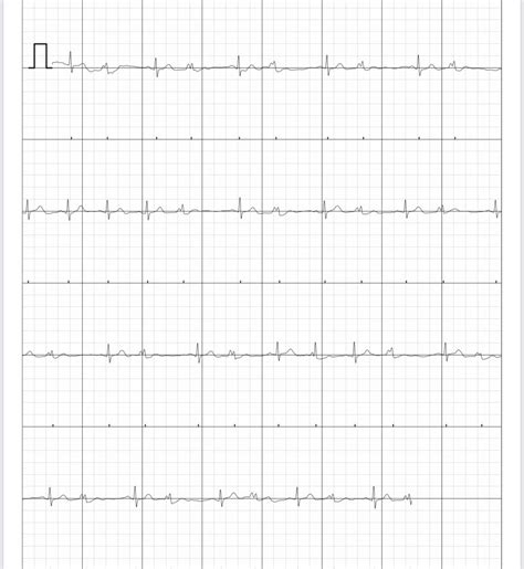 Bigeminy?? : r/PVCs