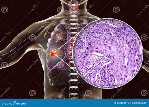 Lung Cancer Cells Diagram