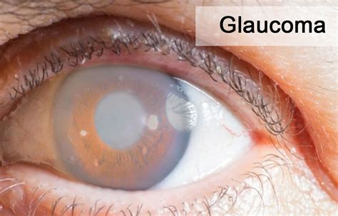 Glaucoma Natural Remedies - My Emerald Health