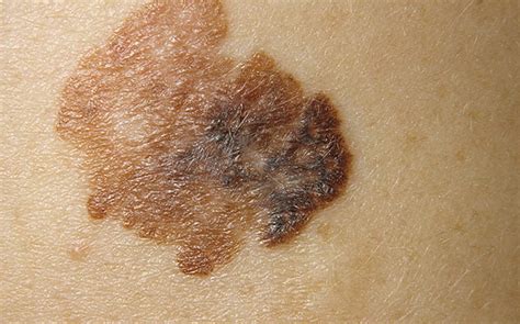 Stage 1 Melanoma Skin Cancer | Images and Photos finder