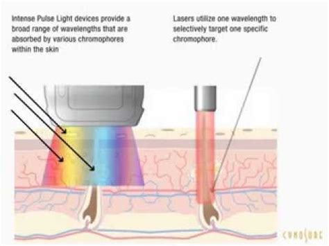 IPL Hair Removal Vs Laser Hair Removal Which Is Better YouTube