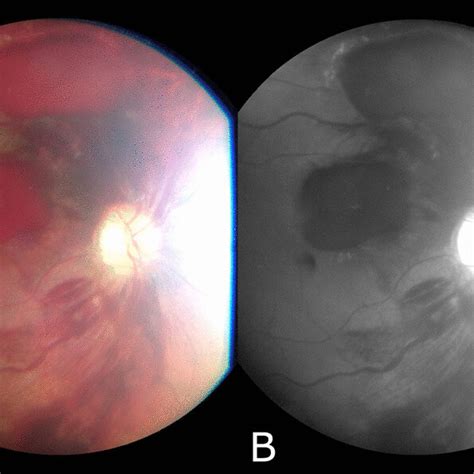 Fundus Image Of The Right Eye Showing Subhyaloid And Intraretinal