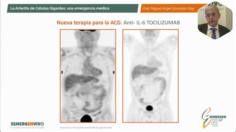 Arteritis De C Lulas Gigantes