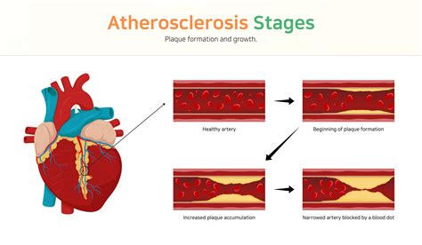 Cardiovascular Disease Nutrition And Physical Fitness