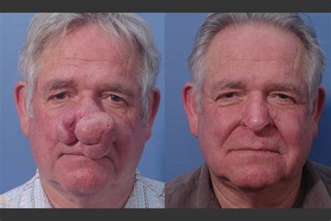 Rhinophyma Treatment & Surgery Options in Seattle-Bellevue WA