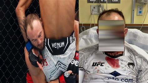 Ufc Fighter Mateusz Rebecki Shows Off Gruesome Facial Injury After Tko