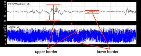 Formation Of The Aeeg Tracing The Signal From The Raw Eeg Upper