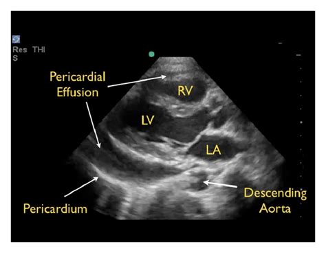 Pericardial Effusion Parasternal Long Axis View Rv Right Ventricle