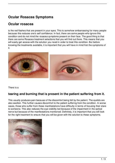 Ocular Rosacea Symptoms