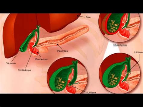 Gastroenterologie Angiocholite Pancr Atite Aigue Chol Cystite Aigue