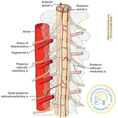 Arteria Espinal Anterior