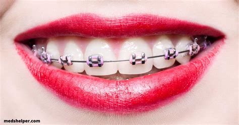 Should you get Purple Braces on Teeth? - Meds Helper