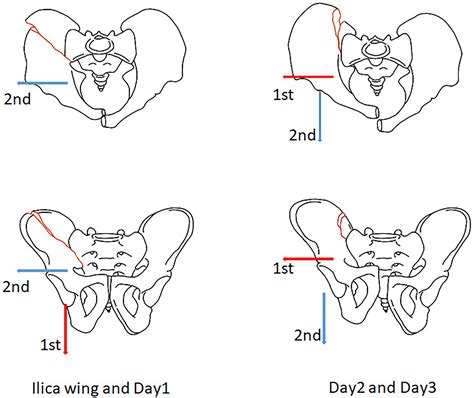 Lateral Compression Type 2 Pelvic FracturesA Clinical Study Of