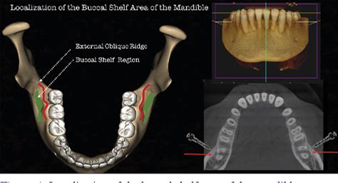 Figure 32 from Infra-Zygomatic Crest and Buccal Shelf - Orthodontic Bone Screws: A Leap Ahead of ...