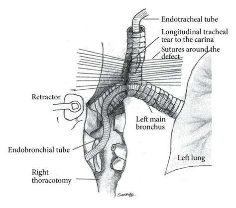 A Sketch Depicting A Tracheal Defect Involving Carina The Two