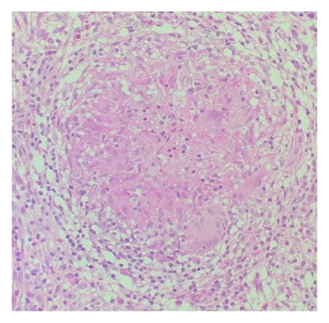 H E Stain Of Synovial Biopsy Showing Granulomatous Inflammation 400x