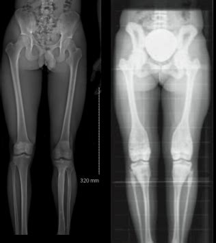 Radiology MSK Flashcards Quizlet