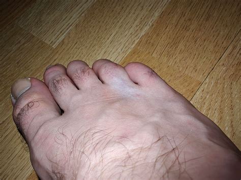 Morton Neurom Morton Neuroma, Mortons Metatarsalgie, Intermetatarsal