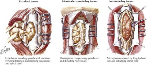 Types Of Spinal Cord Tumors