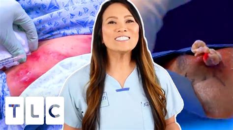 The Top 3 Most Watched Pimple Popping Moments Dr Pimple Popper