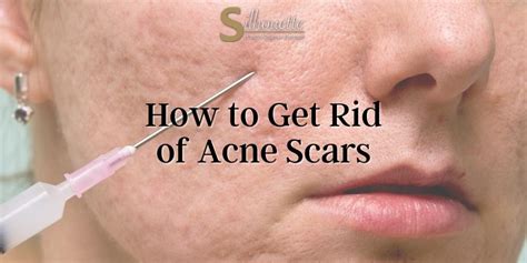 How To Best Treat Acne Scars And Discoloration For Smooth 40 Off