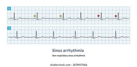 582 Sinus arrhythmia ecg: immagini, foto stock e grafica vettoriale ...