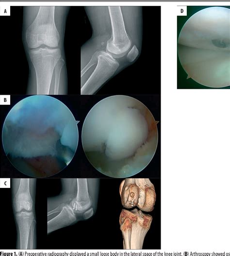 Figure 1 From Arthroscopically Assisted Reduction And Fixation Of An