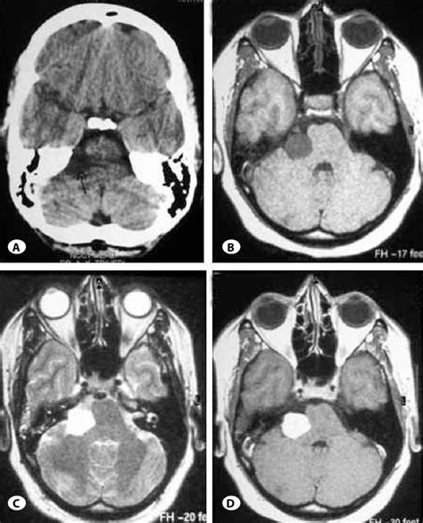 Radiologic Findings A Ct Scan Axial Section Showing Hypodense Lesion