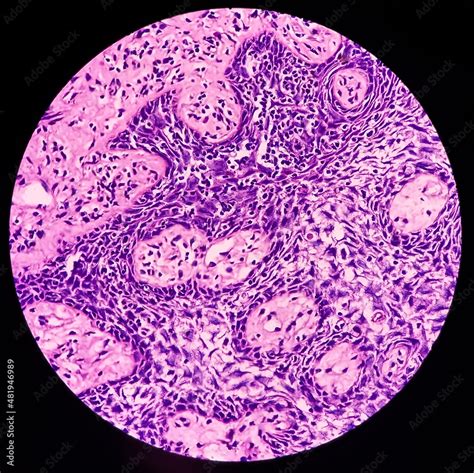 Oral Mucosa Carcinoma Squamous Cell Carcinoma Poorly Differentiated