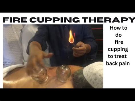 Fire Cupping Or Hijama By Dr Nadeem Islam Tranding India Viral